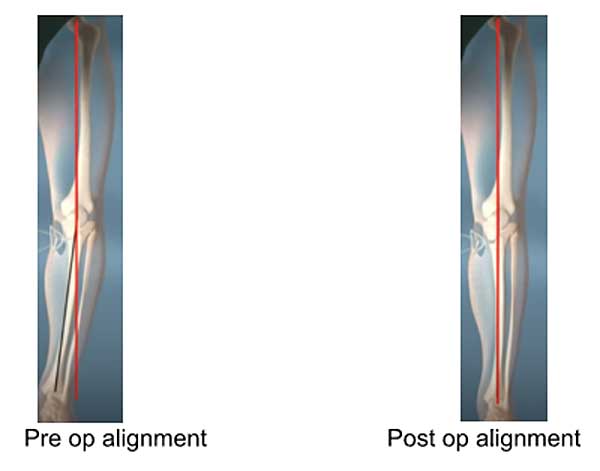 Corrective High Tibial Osteotomy post op and pre op HTO opening wedge on the medial side to shift load to the outside of the knee joint.
